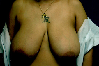 Forest Hills Breast Implants